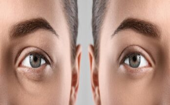 upper blepharoplasty