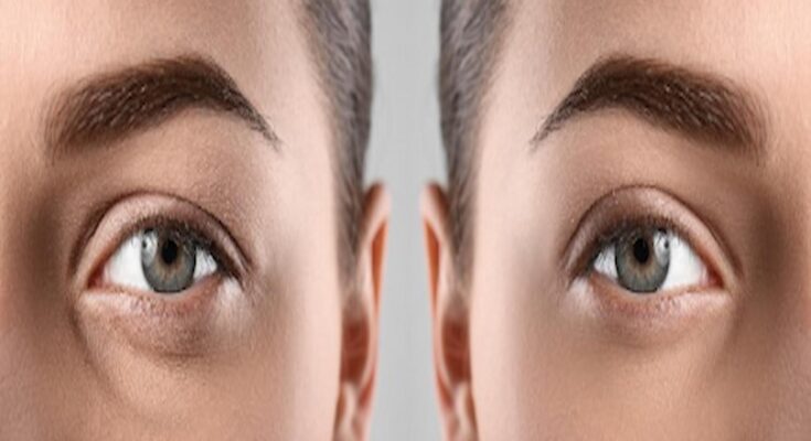 upper blepharoplasty